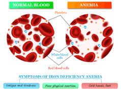 Iron Deficiency Anemia Iron deficiency anemia symptoms, caused by lack of iron, and treatment