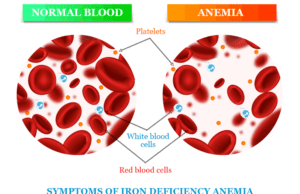 Iron Deficiency Anemia Iron deficiency anemia symptoms, caused by lack of iron, and treatment
