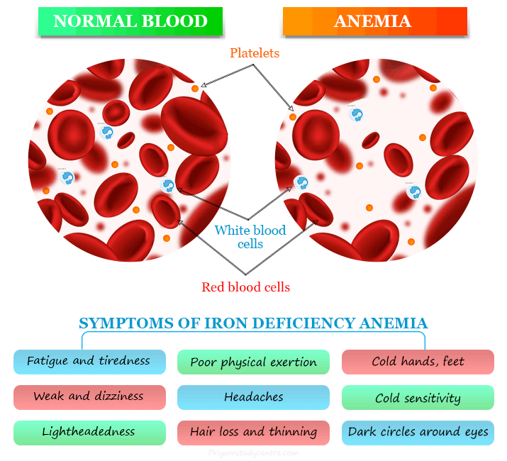 Iron deficiency anemia symptoms, caused by lack of iron, and treatment